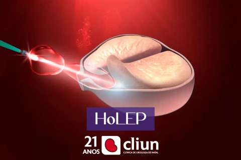 Tecnologia HoLEP: Cirurgia a laser na próstata